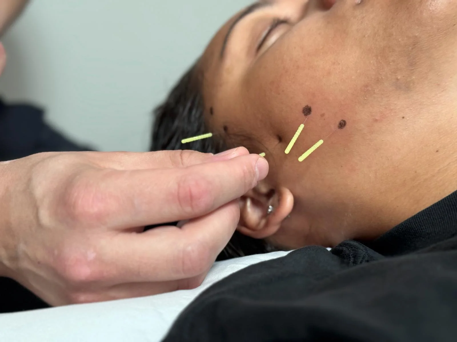 A practitioner placing fine needles along a patient's jaw